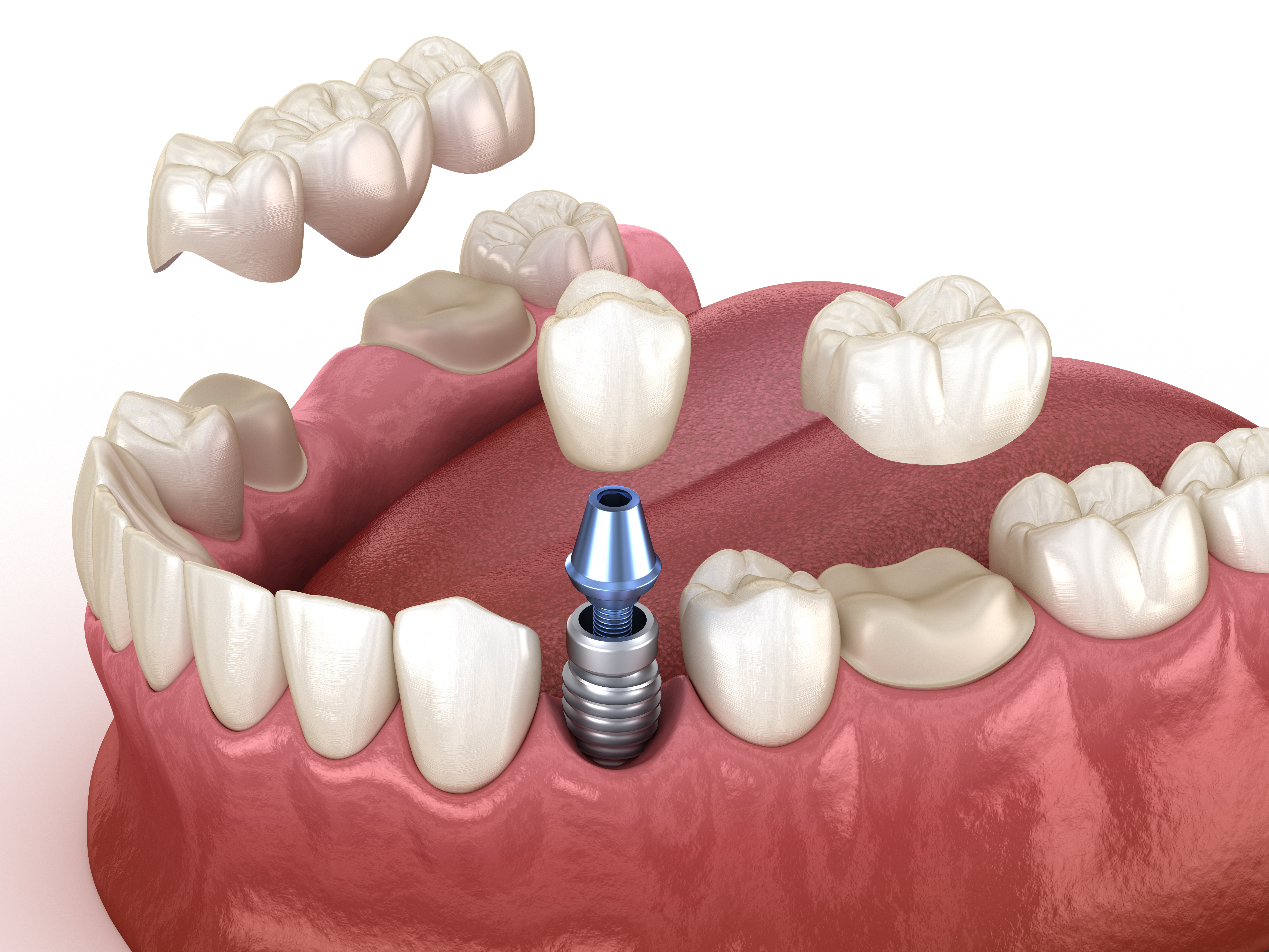 Implantes y prótesis sobre implantes